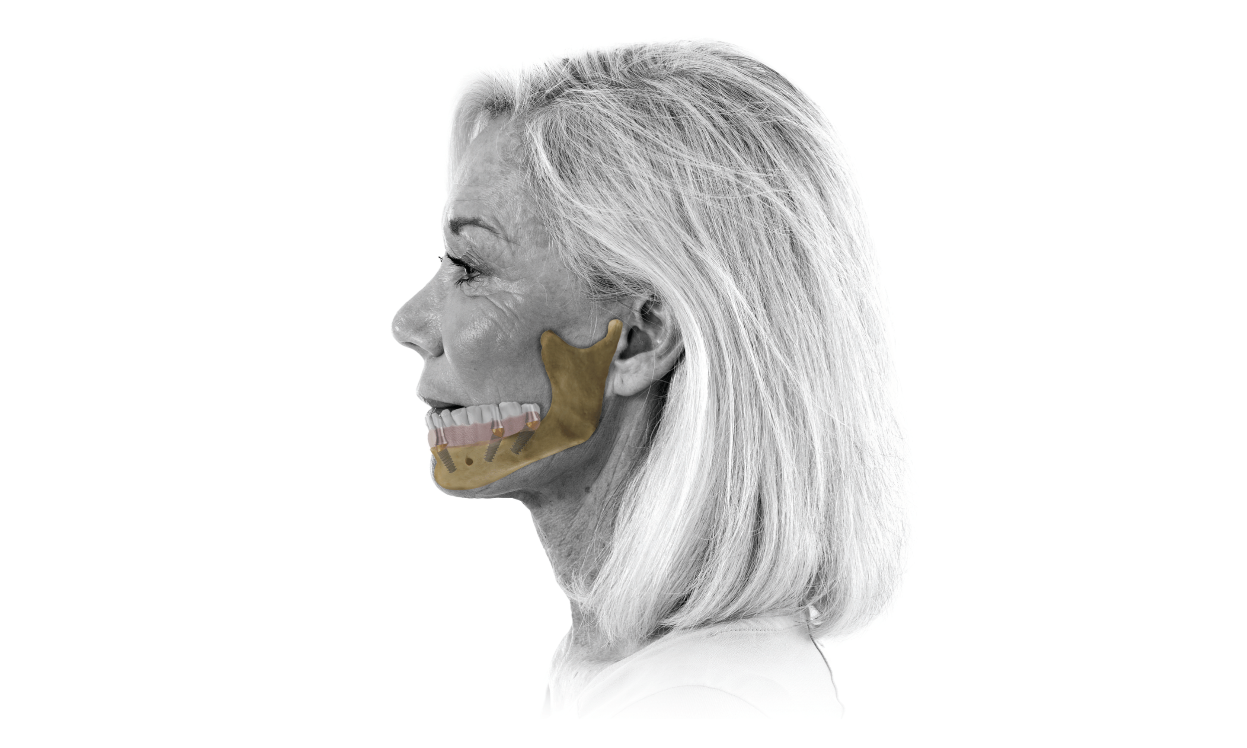 Implant Systems, Surgical Kits & Prosthetic Bundles