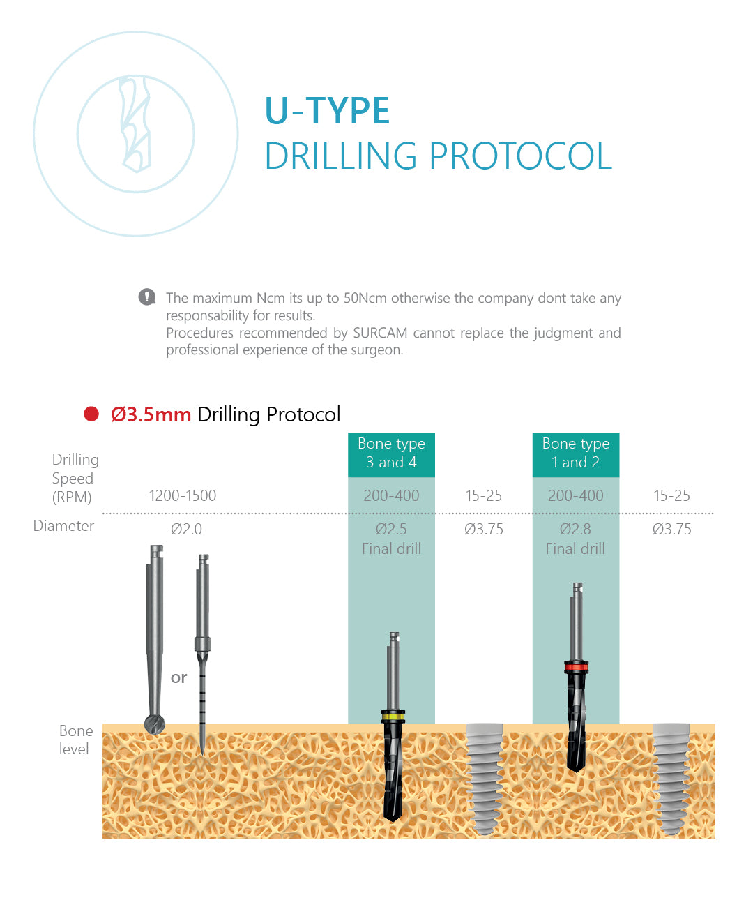 U-Type Dental Implant
