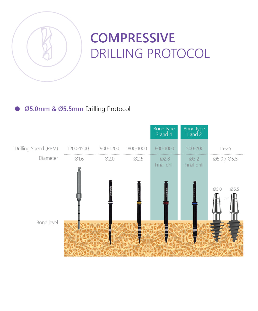Compressive implant with bendable neck up to 30 degrees drilling protocol 5.0 and 5.5