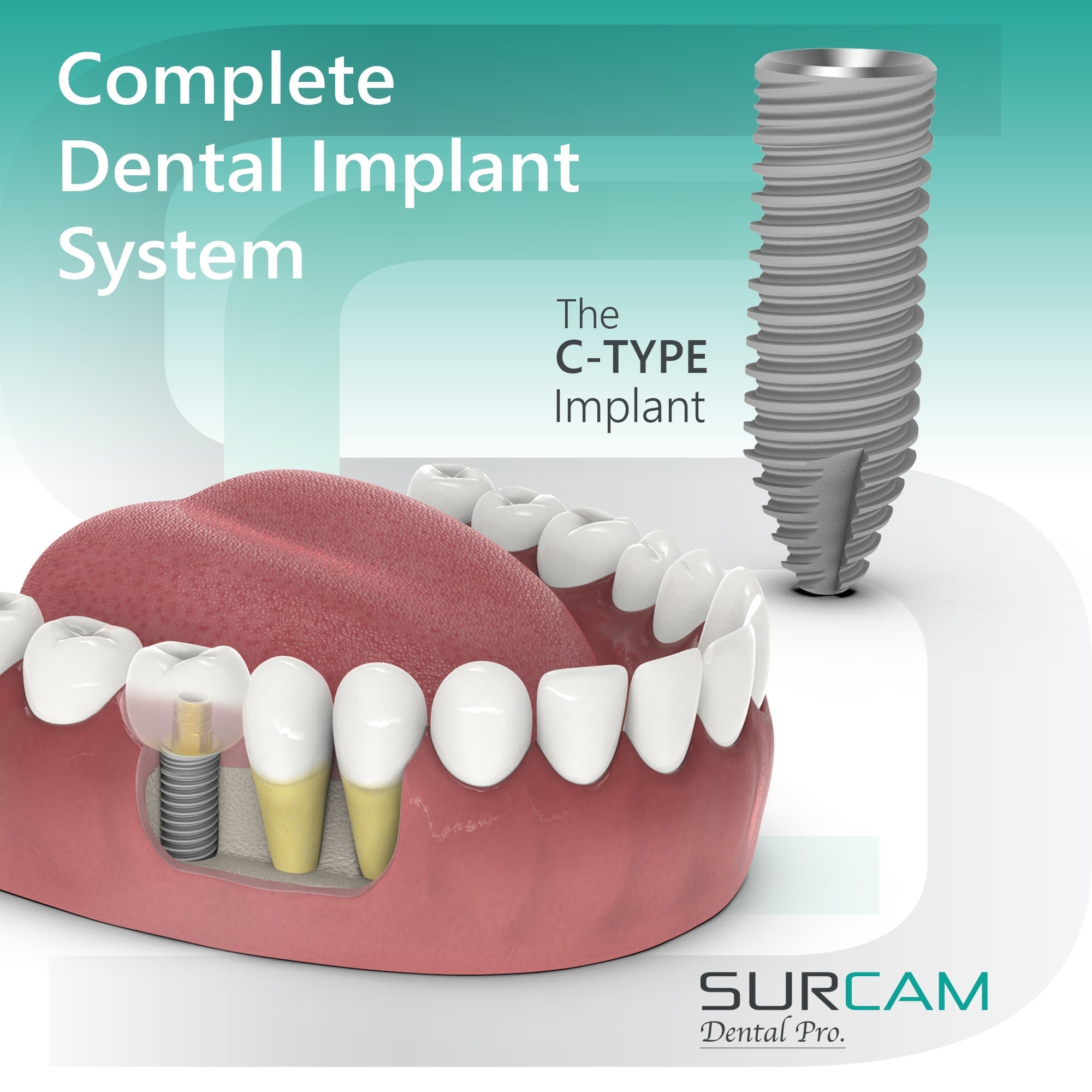 what makes a complete dental implant system?