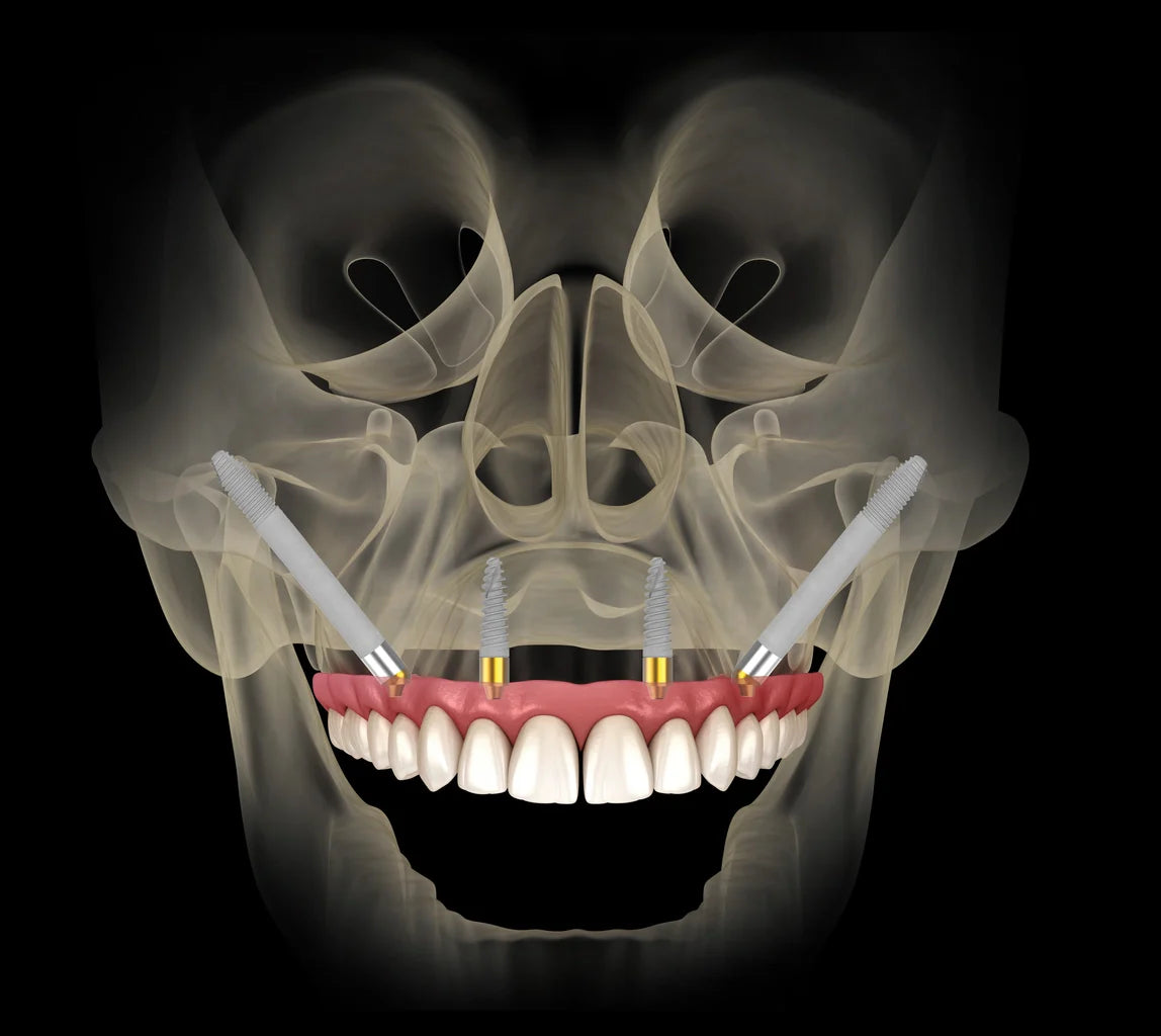 Prof. Samer Sarouji – Zygomatic & Pterygoid Implants