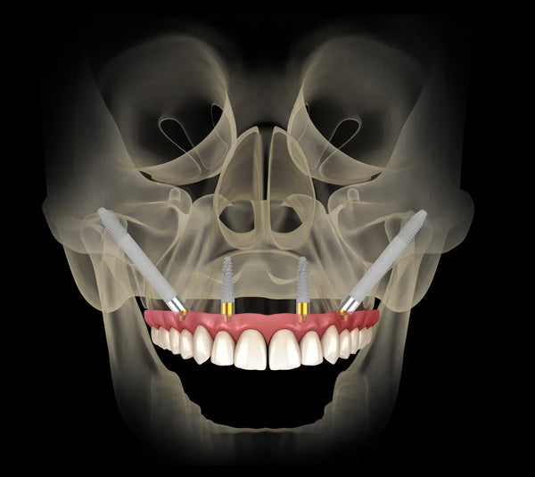 Prof. Samer Sarouji – Zygomatic & Pterygoid Implants