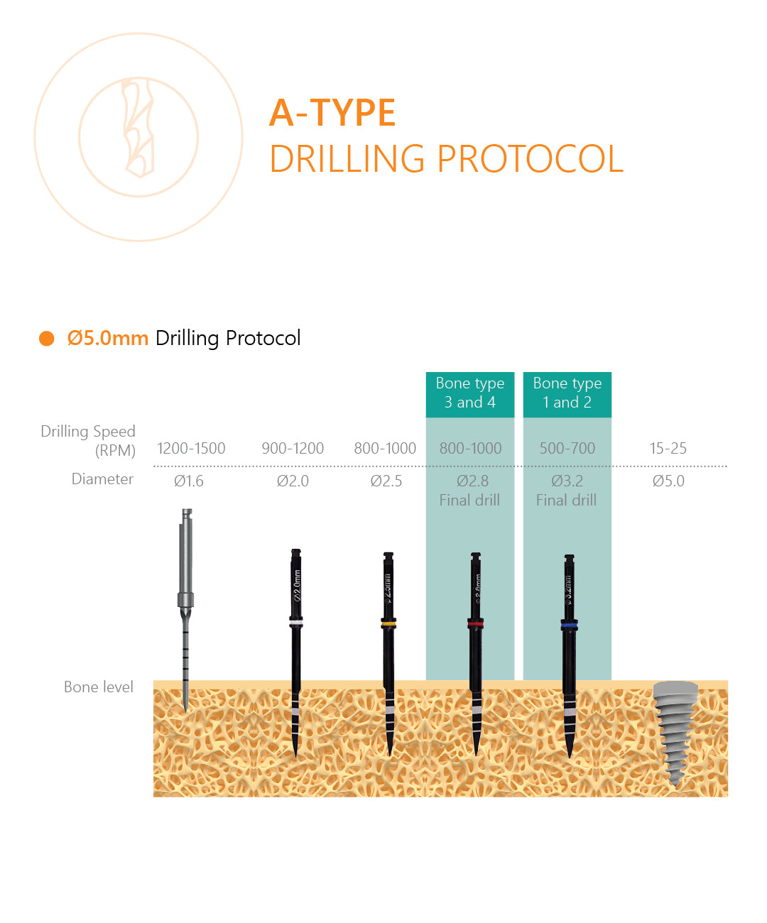 A-Type compressive dental implant Drilling Protocol 5.0