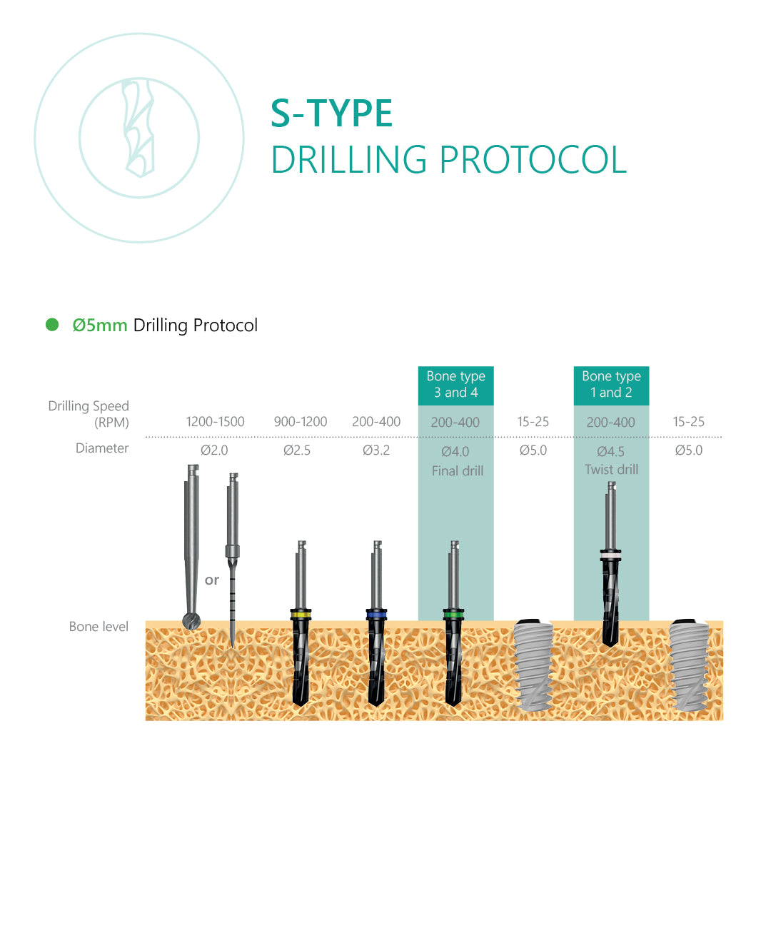 S-Type implant drilling protocol 5.0