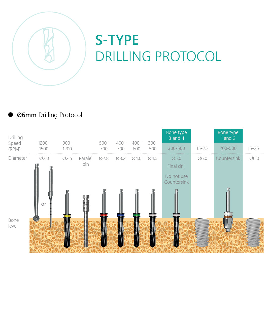 S-Type implant drilling protocol 6.0
