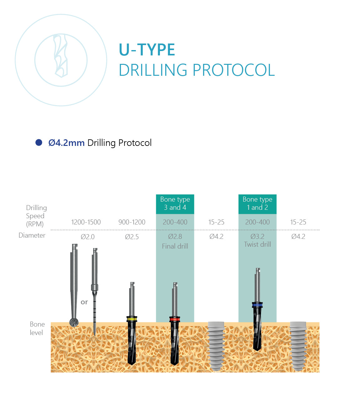 U-Type Dental Implant