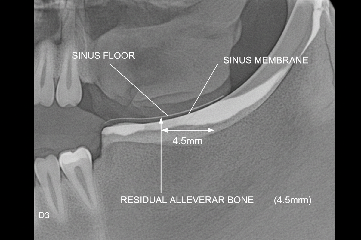 CBCT / radiographic view — Single tooth, soft posterior maxilla — U-Type staged to immediate provisional