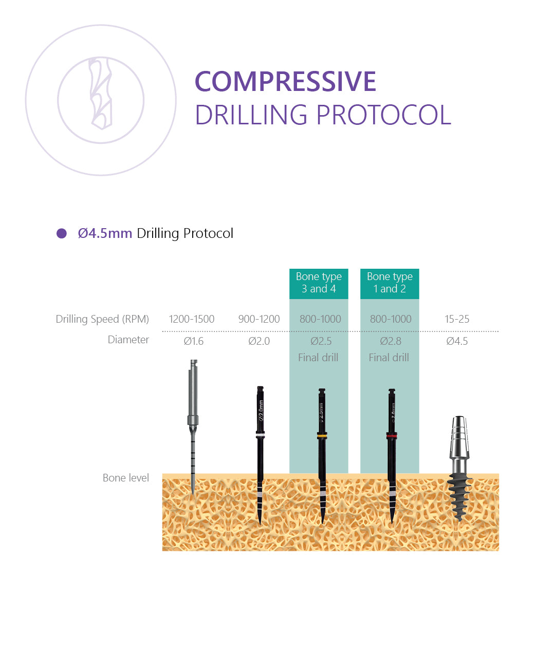 Compressive implant with bendable neck up to 30 degrees drilling protocol 4.5